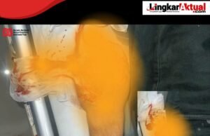 Terancam Cacat Permanen Tangan Seorang Buruh Terjepit Mesin Pabrik PT. Tri Excella Harmony